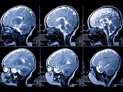 Brain MRI scans showing multiple cross-sections.