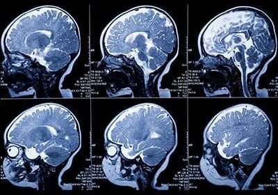 Brain MRI scans showing multiple cross-sections.